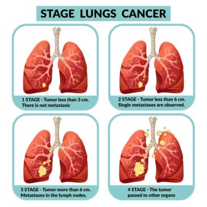Ung thư phổi phát triển qua nhiều giai đoạn