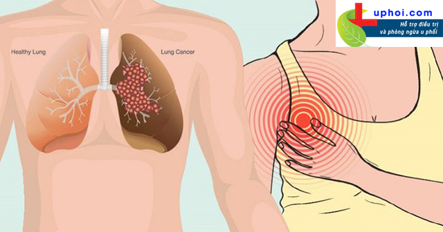 Bệnh ung thư phổi tiến triển qua 4 giai đoạn