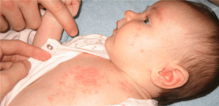    Trẻ bị sốt xuất huyết nên được điều trị sớm