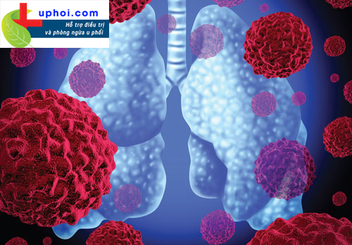 Tỷ lệ mắc ung thư phổi giai đoạn cuối ngày càng tăng cao