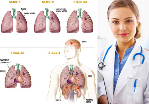 Ung thư phổi là bệnh tiến triển qua nhiều giai đoạn