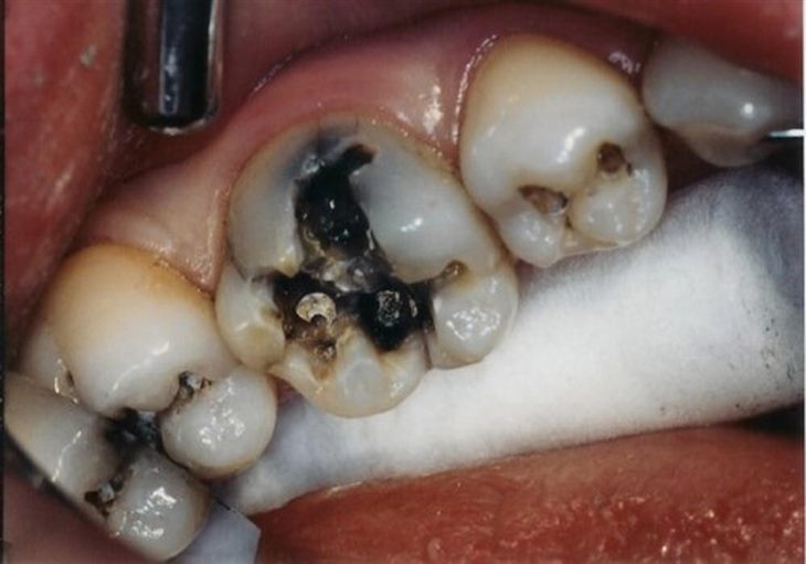 Sâu răng là vấn đề sức khỏe phổ biến