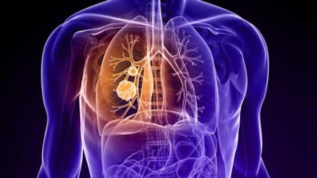 U phổi - Bệnh lý nguy hiểm ngày càng phổ biến