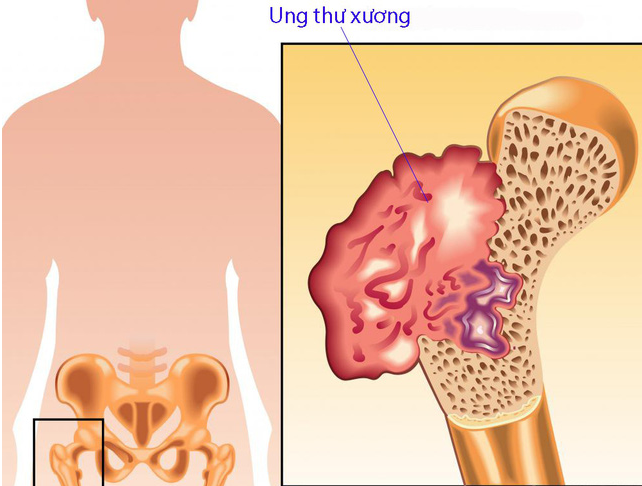 Ung thư phổi di căn xương gây nhiều triệu chứng khác nhau