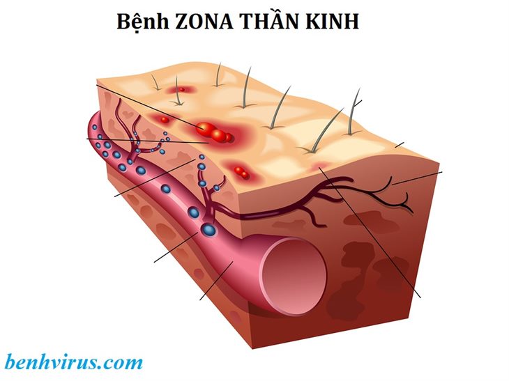   Virus gây bệnh zona tồn tại ở những nơi tập trung nhiều dây thần kinh