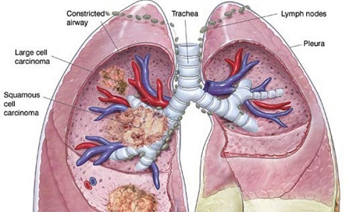 Ung thư phổi có khả năng di căn theo hệ bạch huyết