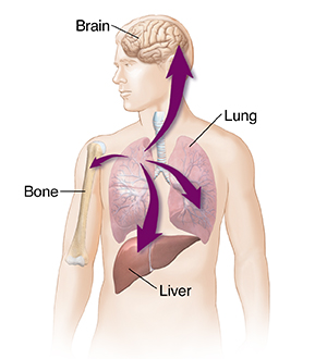 Ung thư phổi có thể di căn đến nhiều cơ quan trong cơ thể