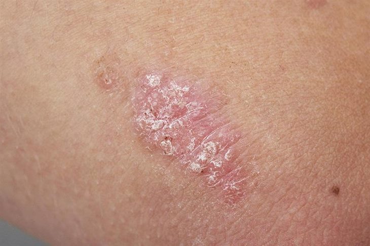 Bệnh vảy nến là gì?