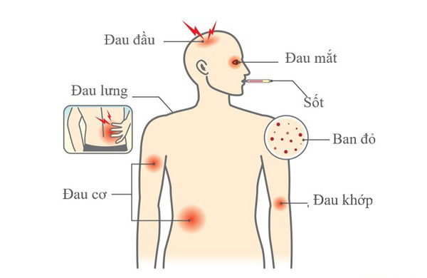    Biểu hiện của bệnh sốt xuất huyết
