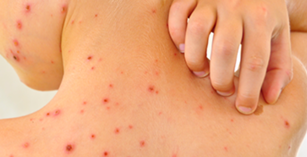 Biểu hiện của sốt xuất huyết là xuất hiện các chấm dưới da