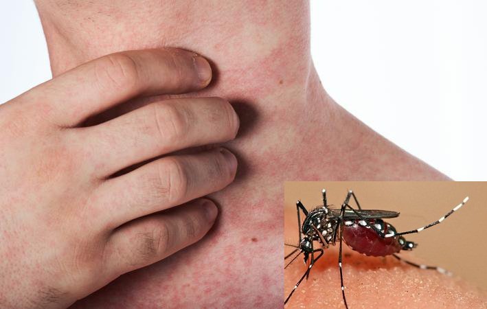    Thoát huyết tương – biến chứng của bệnh sốt xuất huyết