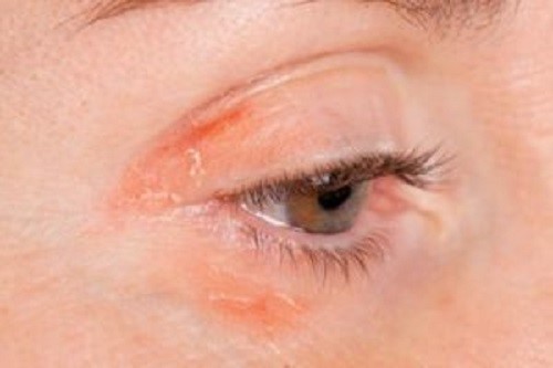 Bệnh vảy nến trên mặt khiến mắt bị khô, cản trở khả năng quan sát