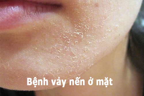 Dấu hiệu của bệnh vảy nến trên mặt