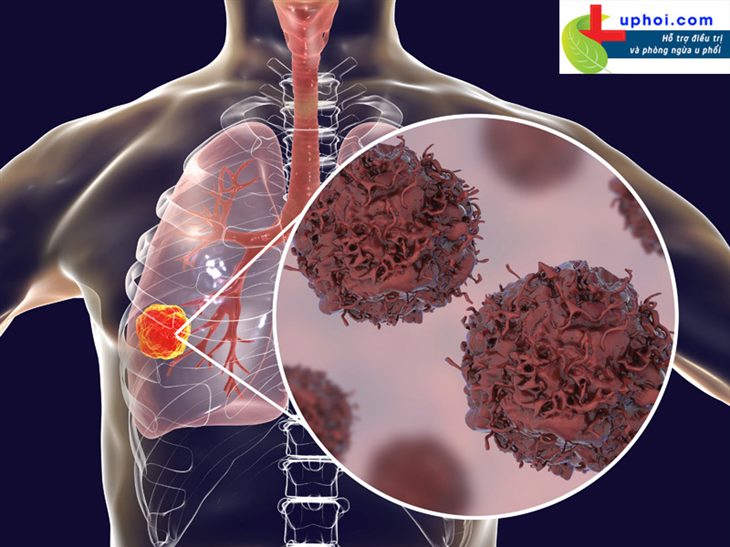U phổi ác tính hình thành do nhiều nguyên nhân khác nhau