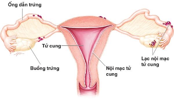 Lạc nội mạc tử cung ảnh hưởng chủ yếu ở phụ nữ trong độ tuổi sinh sản