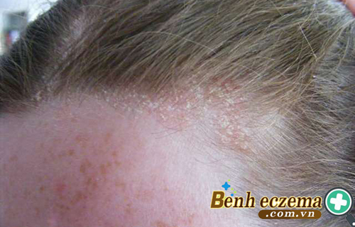 Viêm da tiết bã thường xuất hiện ở da đầu
