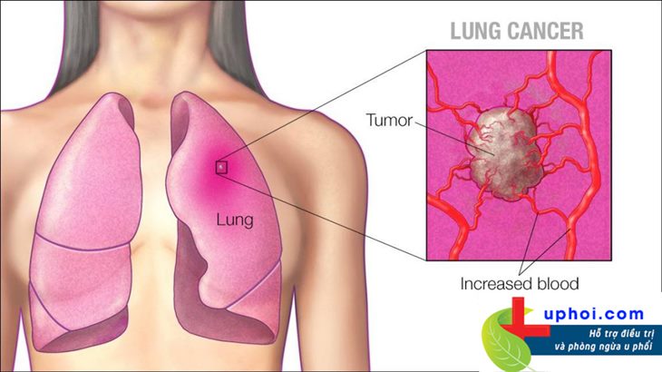 Bệnh ung thư phổi phát triển qua nhiều giai đoạn