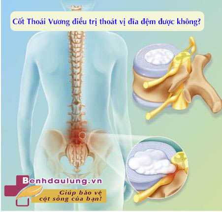 cot-thoai-vuong-dieu-tri-thoat-vi-dia-dem-duoc-khong