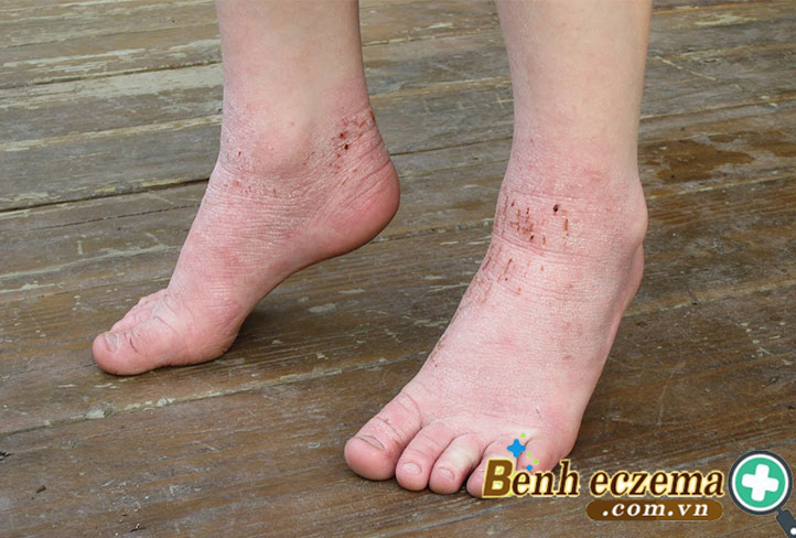 Tổ đỉa thường xuất hiện ở bàn chân