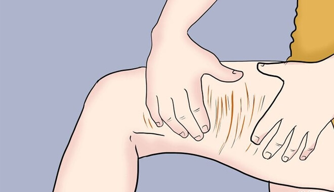    Da bị kéo căng quá mức dễ hình thành vết rạn da
