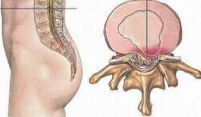 Thoát vị đĩa đệm đa tầng dễ gây biến chứng