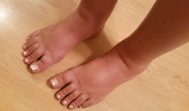 Phụ nữ bị lupus ban đỏ có thể phù bàn chân do chức năng thận bị ảnh hưởng