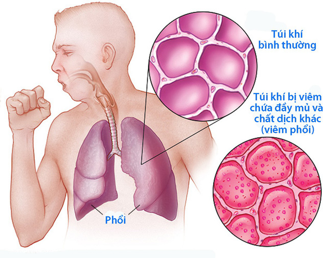  Viêm phổi khiến người bệnh ho lâu ngày không khỏi