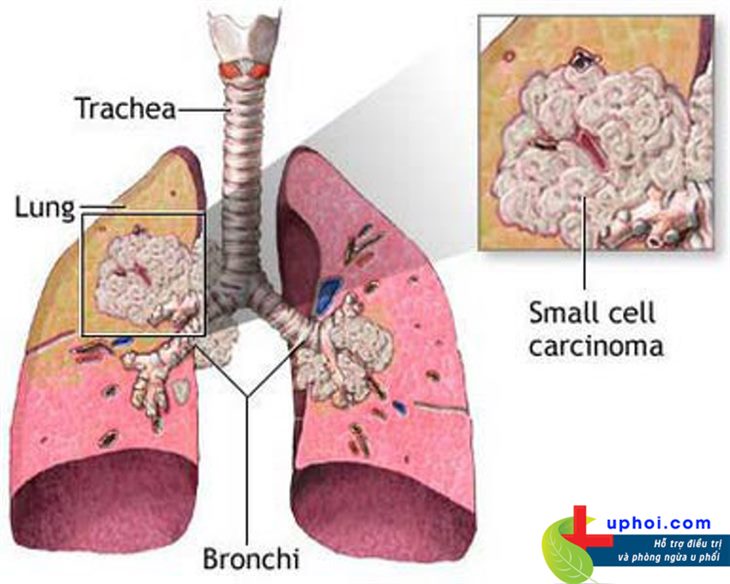 U phổi ác tính là căn bệnh nguy hiểm