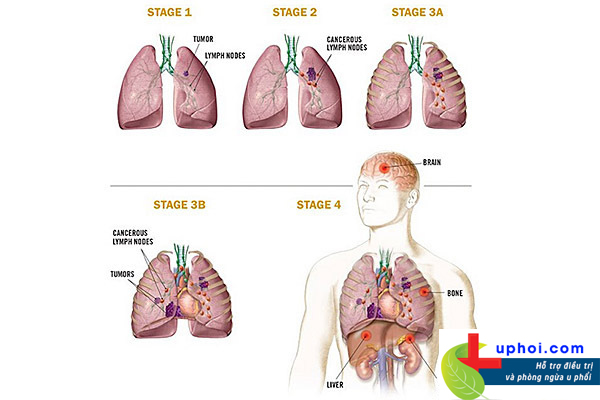 U phổi ác tính tiến triển qua nhiều giai đoạn