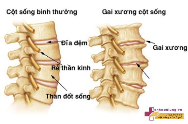 co-che-hinh-thanh-gai-cot-song-nhu-the-nao