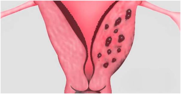 Lạc nội mạc tử cung là một trong những nguyên nhân gây rong kinh