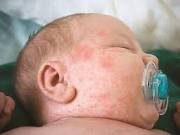 Viêm phổi là biến chứng dễ gặp ở trẻ sơ sinh bị sởi