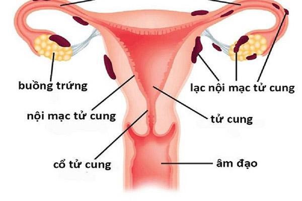 Lạc nội mạc tử cung là tình trạng thường gặp ở phụ nữ độ tuổi sinh sản
