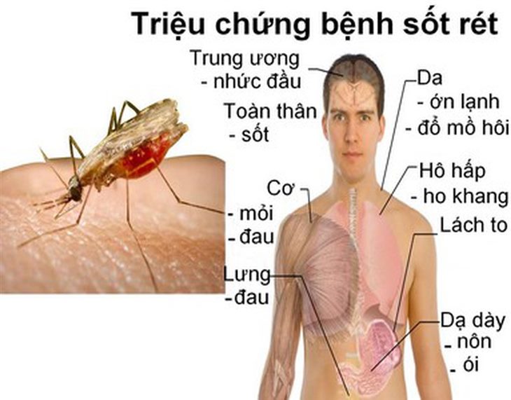   Dấu hiệu của bệnh sốt rét