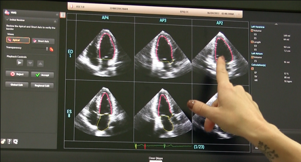    Hình ảnh siêu âm khối echo trong tử cung