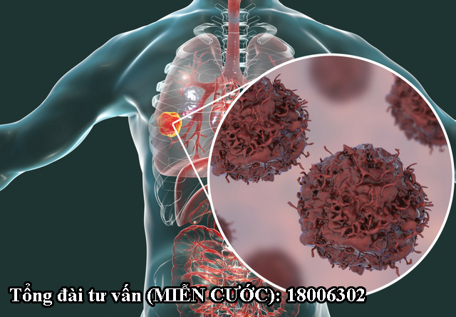 Khối u ở phổi có nguy cơ tái phát sau phẫu thuật