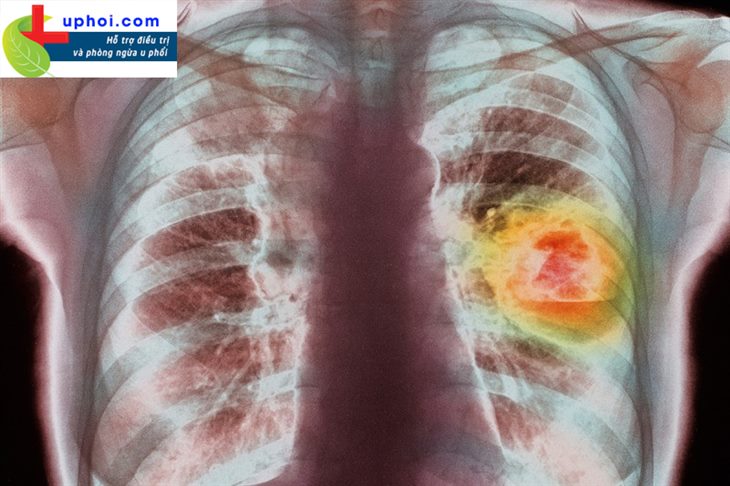 Ung thư phổi có thể do nhiều nguyên nhân gây ra