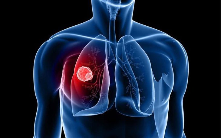 U phổi có tỷ lệ tử vong cao