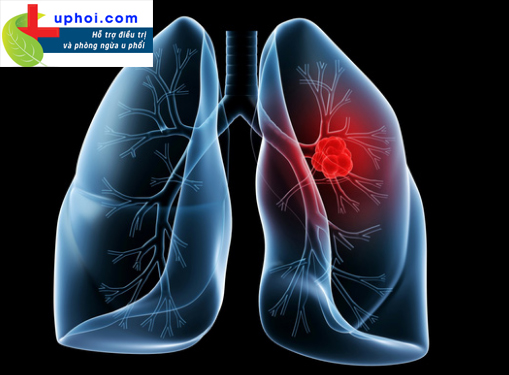 Ung thư phổi là bệnh lý nguy hiểm