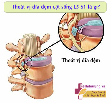 thoat-vi-dia-dem-cot-song-l5s1-la-gi