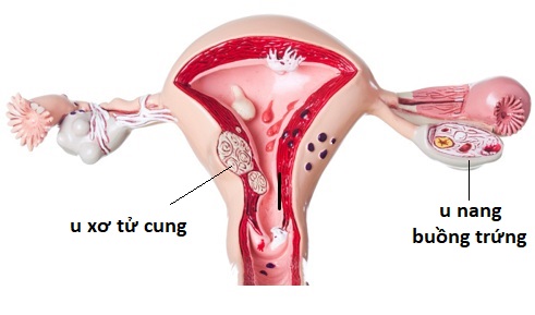    Hình ảnh bệnh u xơ tử cung, u nang buồng trứng