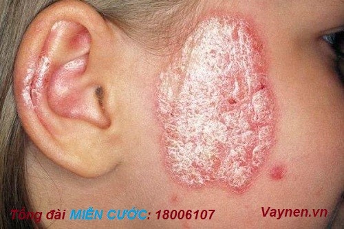 Triệu chứng của bệnh vảy nến da mặt ở tai