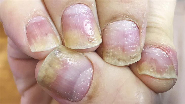 Bệnh vảy nến móng tay gây ra các lỗ nhỏ trên móng tay