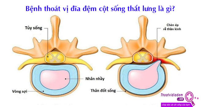 benh-thoat-vi-dia-dem-cot-song-that-lung-la-gi
