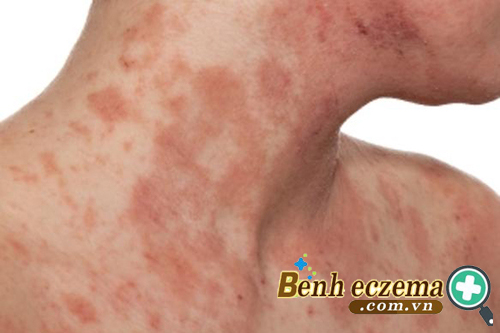  Phát ban trên da là triệu chứng rất thường gặp khi bị viêm da tiếp xúc