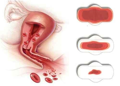    Thiếu máu – Biến chứng nguy hiểm của bệnh u xơ tử cung