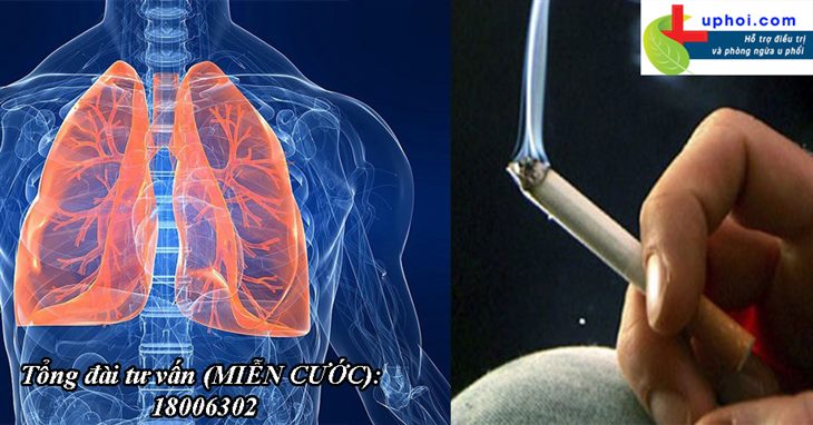 Thuốc lá là nguyên nhân hàng đầu gây u phổi