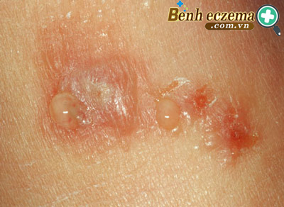  Da bị phồng rộp là triệu chứng thường thấy ở bệnh viêm da tiếp xúc