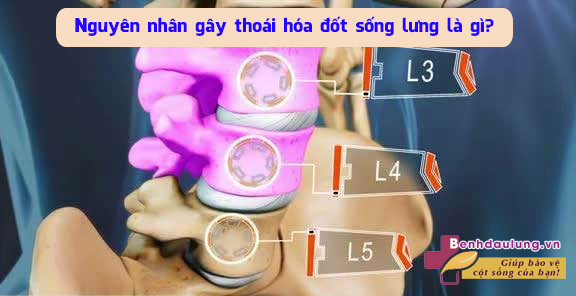 nguyen-nhan-gay-thoai-hoa-dot-song-lung-la-gi