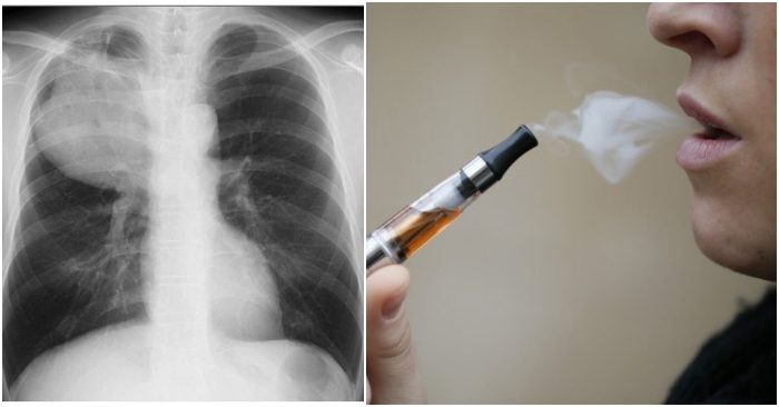 Thuốc lá điện tử có gây ung thư phổi không?